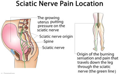 Sciatica While Pregnant