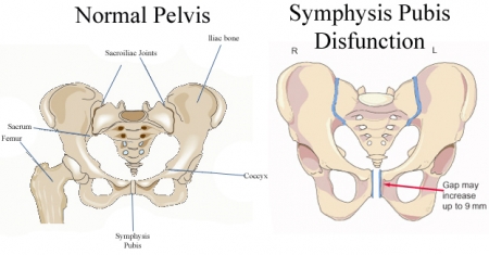 SYMPHYSIS PUBIS DYSFUNCTION - PREGNANCY PELVIC DISCOMFORT AND PAIN